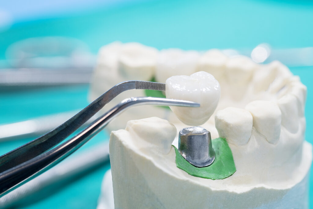 Colocando um implante nos dentes