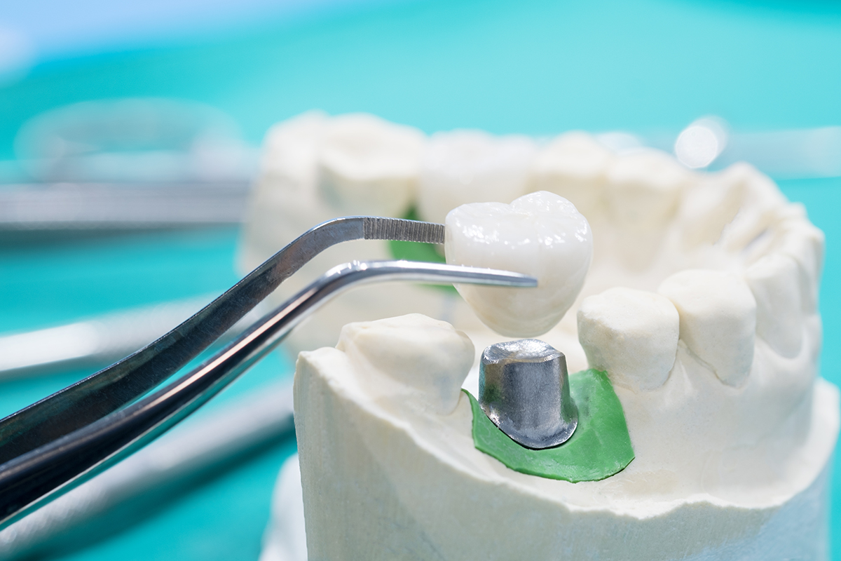 Enxertos ósseos na odontologia
